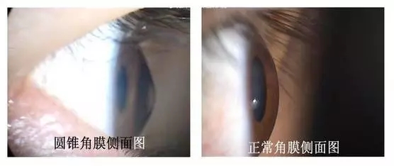 角膜膠原交聯(lián)術(shù)早期圓錐角膜
