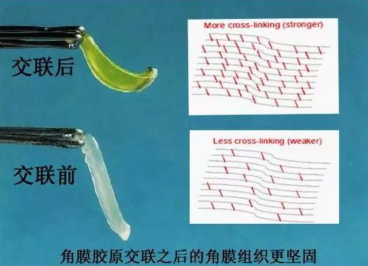 角膜膠原交聯(lián)術(shù)早期圓錐角膜