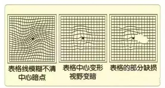 眼底病會引起的6大危害，看圖自測眼底病。