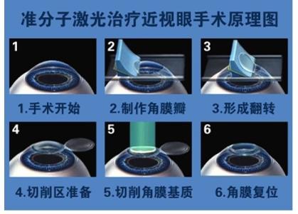 準分子手術臨床技術操作規范