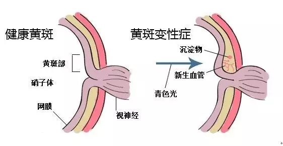 【科普】葉黃素是防止黃斑病變致老年致盲的“視黃金”