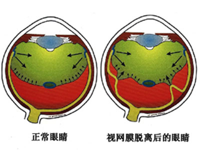 視疲勞可導致視網膜脫落？！