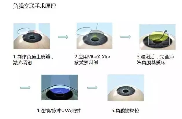 北京去哪治圓錐角膜好？！