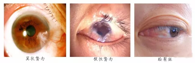 眼睛里長“肉”，當心翼狀胬肉！翼狀胬肉多少錢？