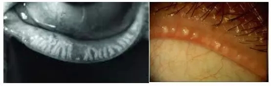 眼睛干澀痛，一查竟角膜上皮損傷嚴重、腺體萎縮！