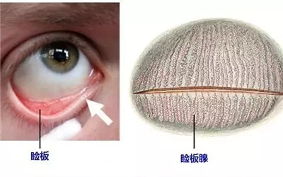 眼睛干澀痛，一查竟角膜上皮損傷嚴重、腺體萎縮！