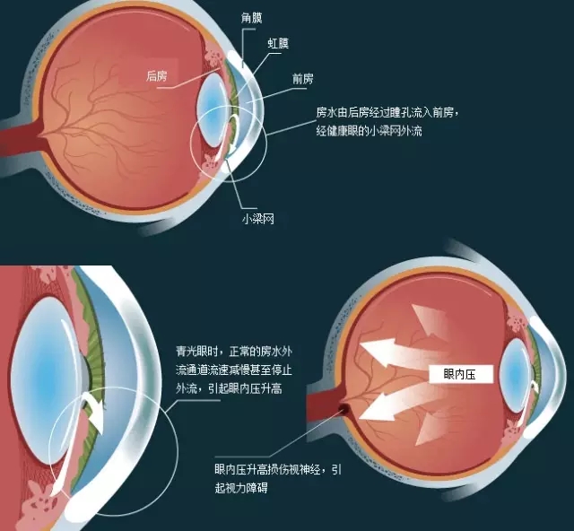 各類型青光眼原則