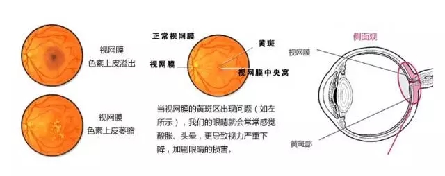 老年性黃斑變性，從年輕時就要開始防護