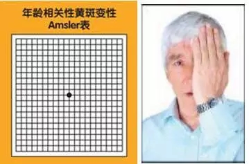 老年性黃斑變性，從年輕時就要開始防護