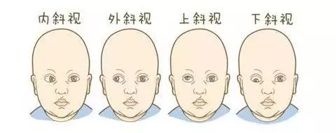 孩子斜視弱視不及時(shí)，導(dǎo)致毀一生？專家告訴您真相！