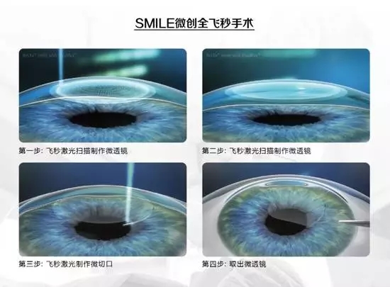 近視手術(shù)已經(jīng)進入“綠色全飛秒時代”
