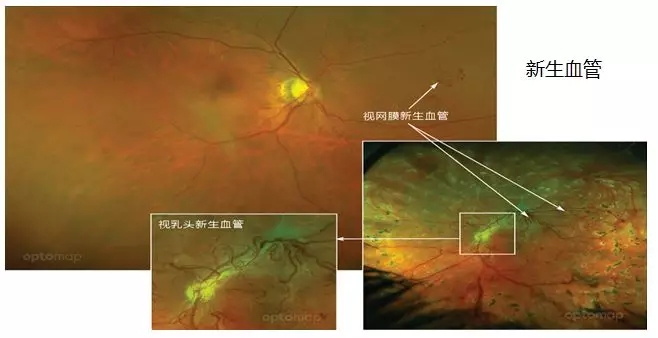 非接觸、免散瞳、超廣角眼底檢查不是夢！