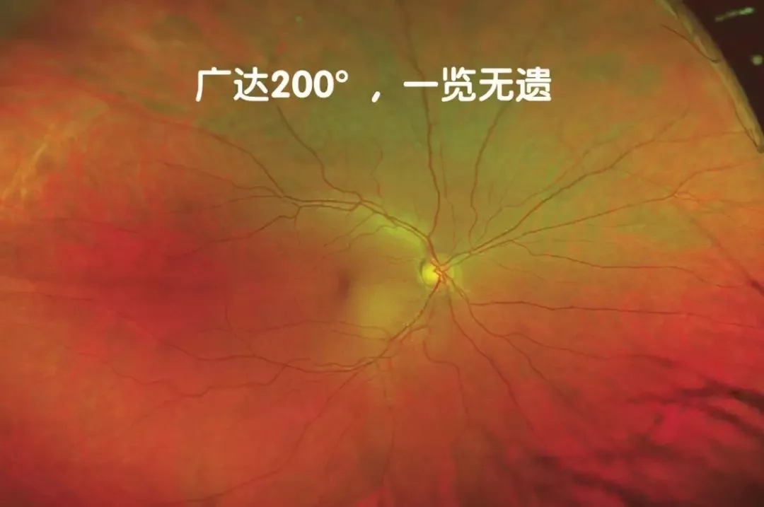 非接觸、免散瞳、超廣角眼底檢查不是夢！