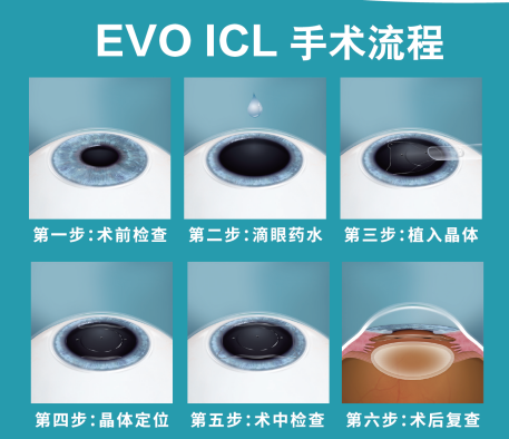 暑期摘鏡總動員-近視矯正黑科技 ICL晶體知多少