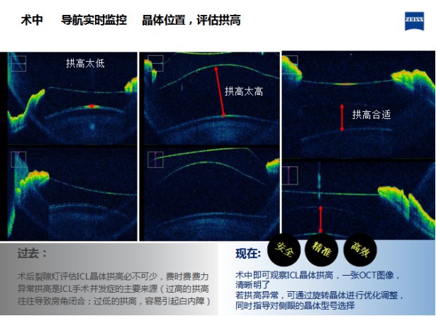 暑期摘鏡總動員-近視矯正黑科技 ICL晶體知多少