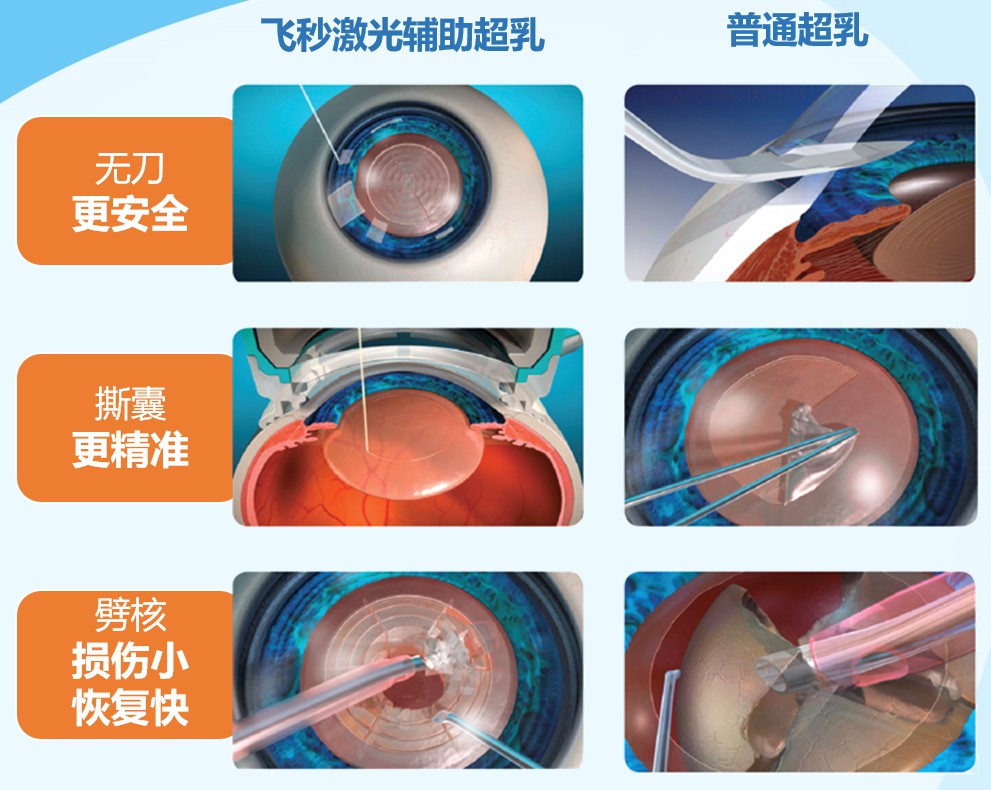 無刀金準 溢顯卓越——華德眼科被授予“飛秒激光白內障手