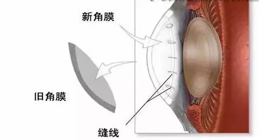 哪些眼病需要做角膜移植手術？